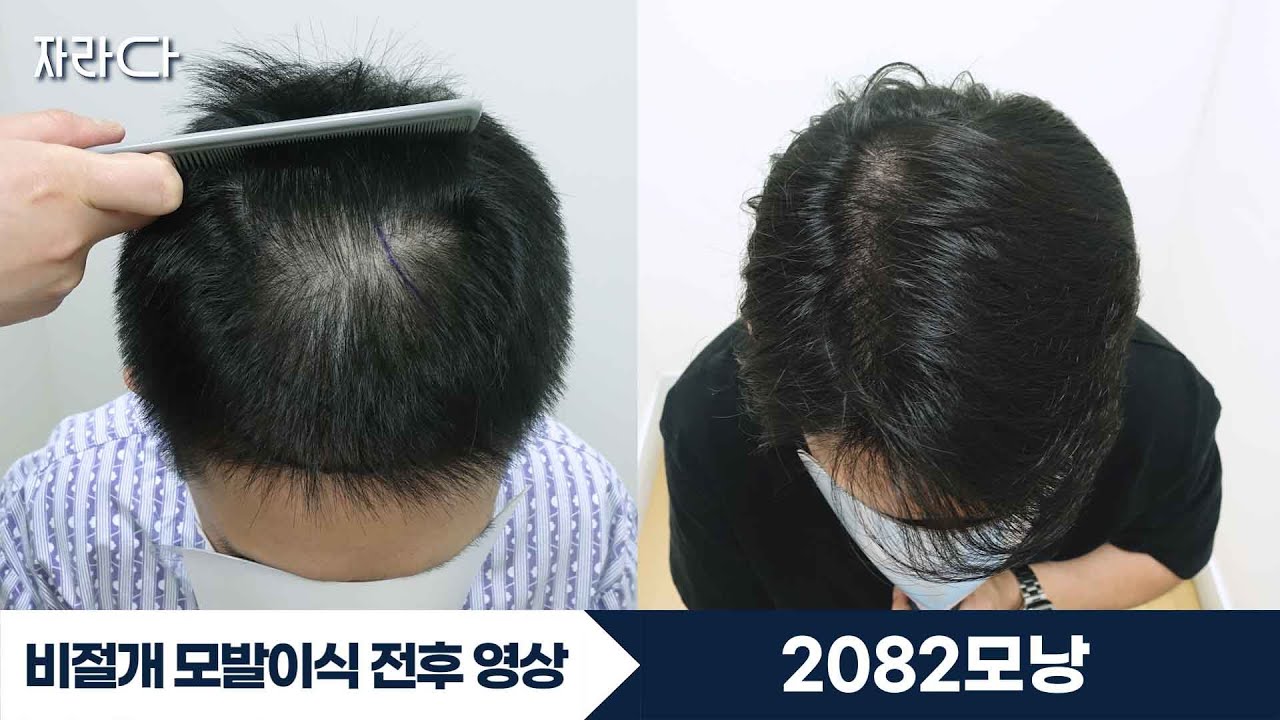 2082모낭 비절개모발이식 전두부 헤어라인 #자라다의원 - Youtube 2082모낭 비절개모발이식 전두부 헤어라인 #자라다의원 - Youtube