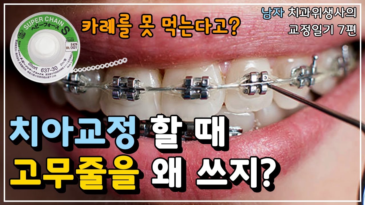 치아교정 할 때 고무줄을 쓰는 이유ㅣ교정 고무줄ㅣ파워체인ㅣ남자 치과위생사의 교정일기 7편ㅣ교정 착색ㅣ교정 후기ㅣ교정 전후 -  Youtube