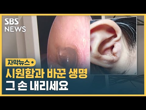 귀 가렵다고 함부로 파면 벌어지는 일 (자막뉴스) / SBS