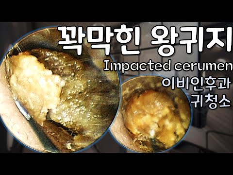 [귀팡ASMR] 꽉 막힌 왕귀지 Impacted cerumen removal_이비인후과 귀청소